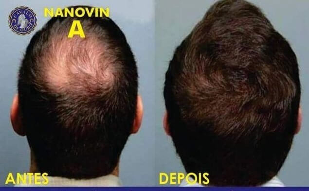 Nanovin Resultado